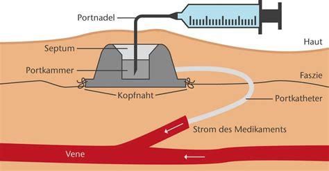 port nicht rückläufig|Portversorgung, Portpflege: Anleitung und Prophylaxe。